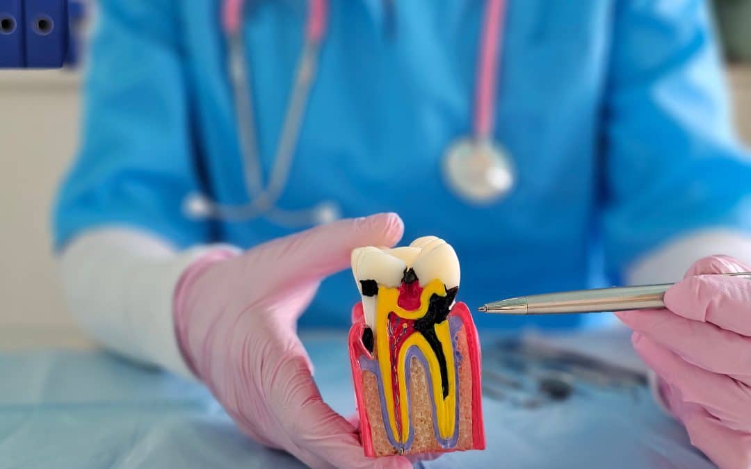 What Are Common Reasons Root Canals Fail and How Are They Treated?